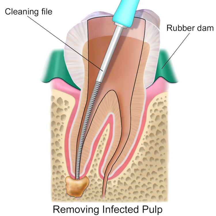 root-canal-transparent_image