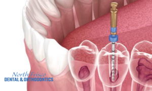 Root Canal Treatment.