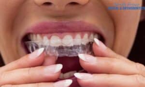 Invisalign in Frisco, TX, North Frisco Dental & Orthodontics