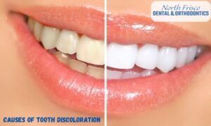 Causes Of Tooth Discoloration