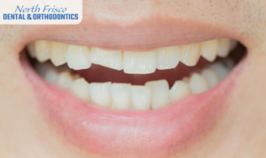 Fix A Cracked or Broken Tooth