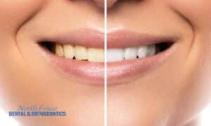 Advantages of Professional Teeth Whitening