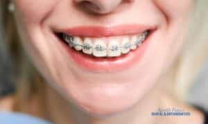 How Do You Take Care of Your Teeth with a Brace or a Retainer