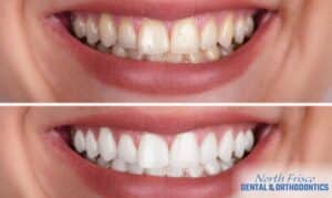 In-Office Teeth Whitening is Worth the Cost