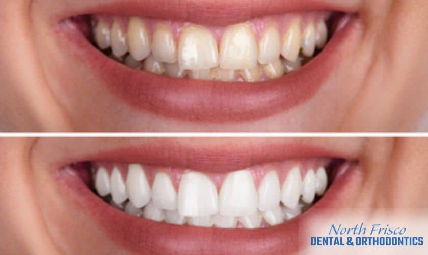 In-Office Teeth Whitening is Worth the Cost