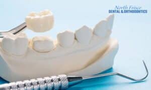 Ways to Avoid Losing Your Dental Crown