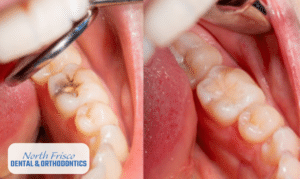 Simple Steps to Ensure Your Dental Sealants Last Longer