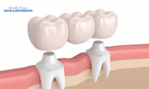 When To Consider Dental Bridges Signs And Symptoms