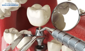 When To Consider Dental Implants