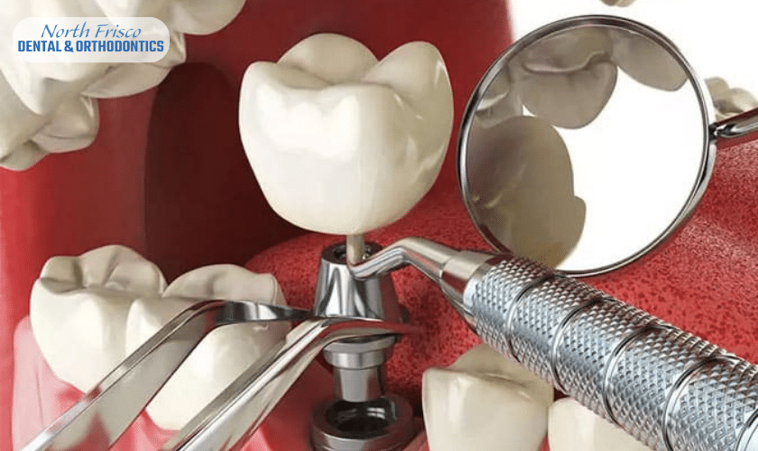 When To Consider Dental Implants