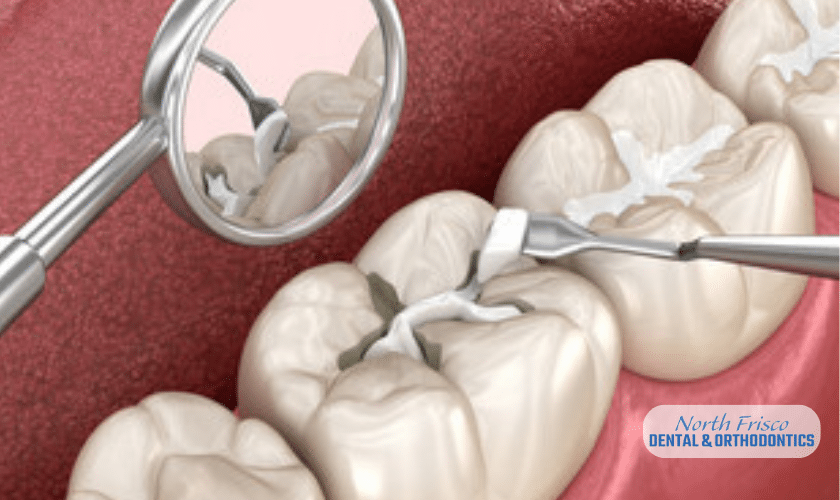 tips to take care of your dental fillings