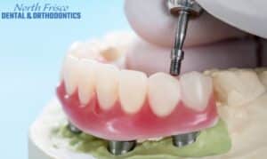 What You Need to Know About Overdentures: A Complete Guide