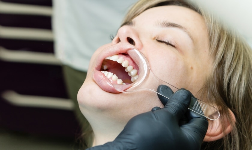 Adult Orthodontics in Frisco, TX, North Frisco Dental