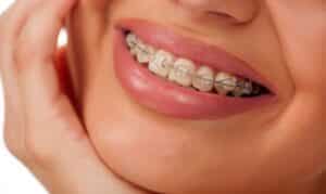 Braces in Frisco, TX, North Frisco Dental & Orthodontics