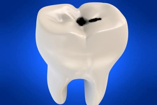 img-Silver-Diamine-Fluoride