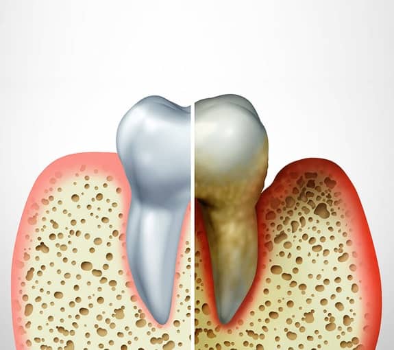 img-What-is-Gum-Disease-Periodontal-Therapy-min