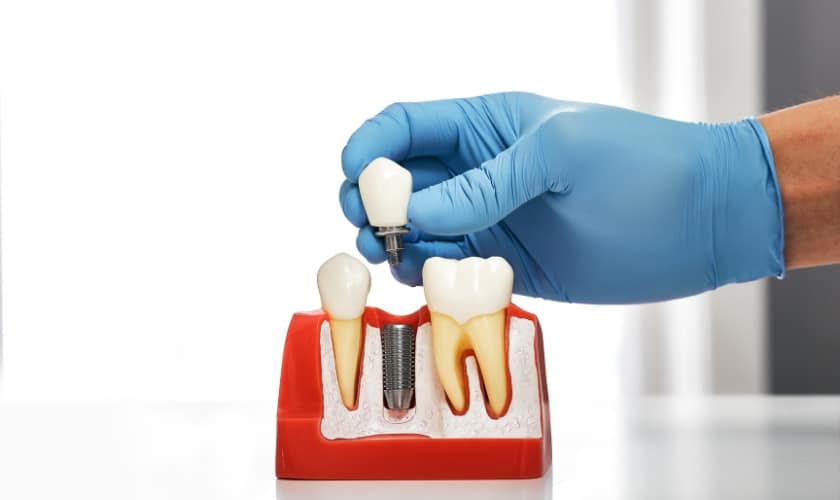 Dental Implants in Frisco, TX, North Frisco Dental & Orthodontics