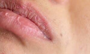 Dry Mouth in Frisco, TX, North Frisco Dental & Orthodontics