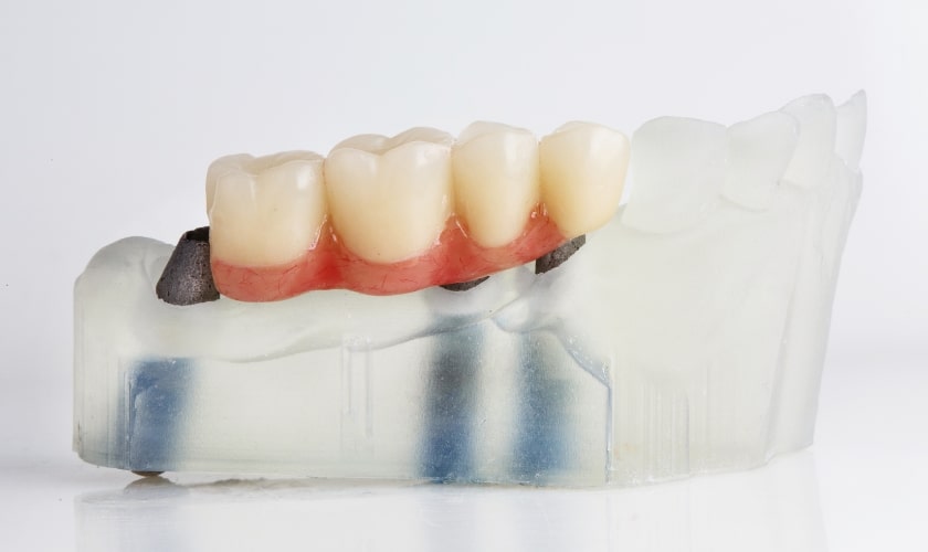 Dental Bridge in Frisco, TX, North Frisco Dental & Orthodontics