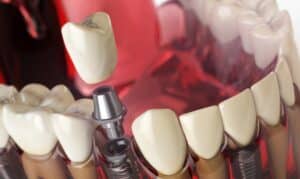 Dental Crown Frisco, TX, North Frisco Dental & Orthodontics