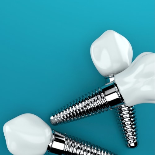 Dental Implants in Frisco, TX, North Frisco Dental & Orthodontics