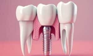 Dental Implants in Frisco, TX, North Frisco Dental & Orthodontics