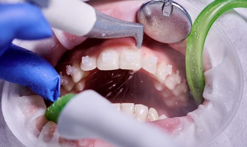 Orthodontic Treatment in Frisco, TX, North Frisco Dental & Orthodontics