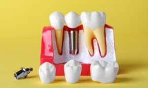Dental Implants in Frisco, TX, North Frisco Dental & Orthodontics