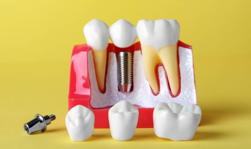 Dental Implants in Frisco, TX, North Frisco Dental & Orthodontics