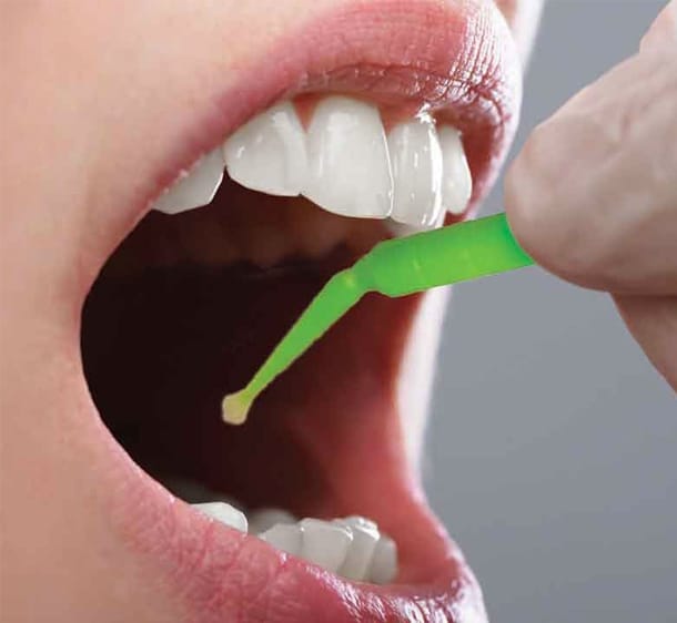 Silver Diamine Fluoride in Frisco