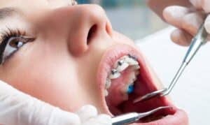 Dental Braces in Frisco