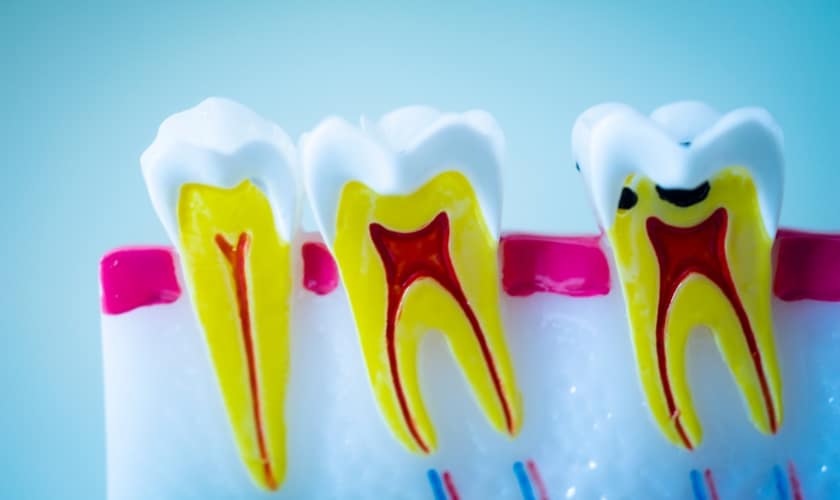 root canal aftercare tips