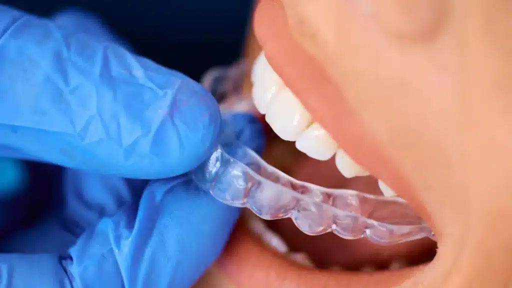 10 Things to Know Before Starting an Invisalign Treatment