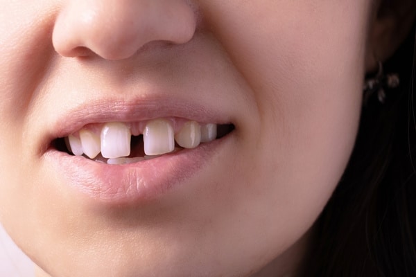 can dental bonding fix gaps between teeth
