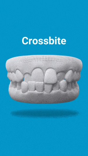 img-gif-Crossbite
