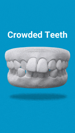 img-gif-Crowded-Teeth