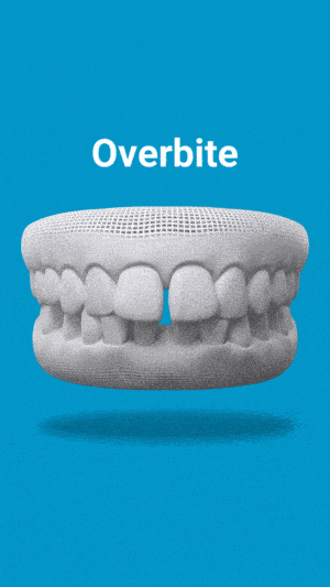 img-gif-Overbite