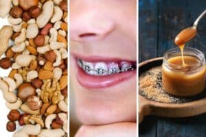 thanksgiving foods to avoid if you wear braces