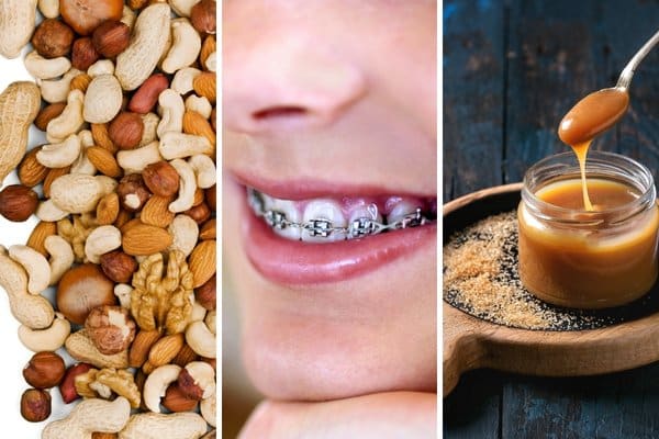 thanksgiving foods to avoid if you wear braces