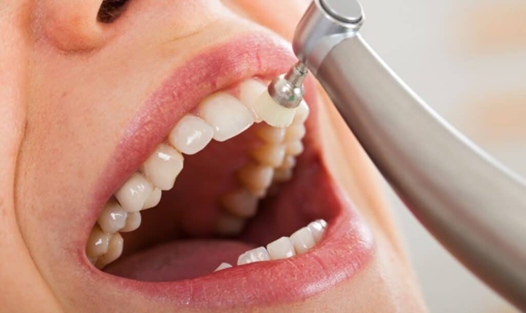 Top Benefits Of Regular Professional Dental Cleaning