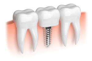 Are You A Good Candidate For Dental Implants? Key Considerations