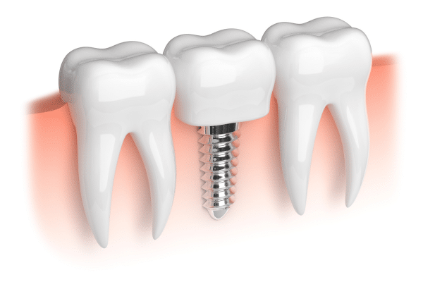 Are You A Good Candidate For Dental Implants? Key Considerations