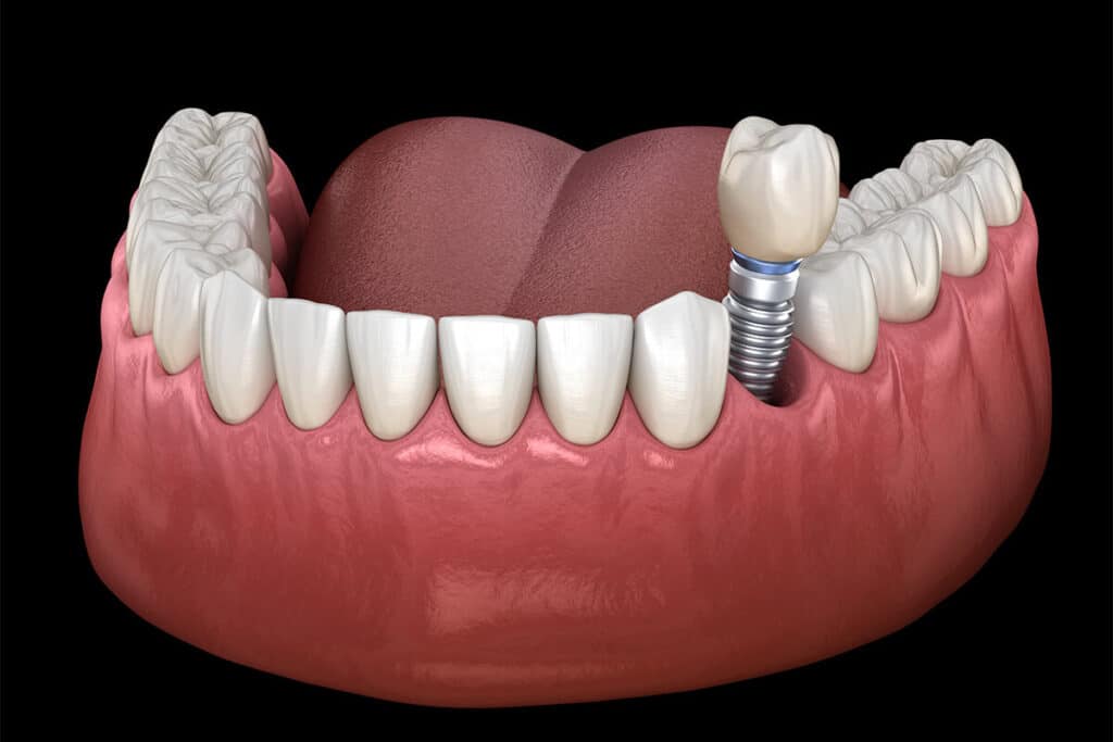 is dental implant surgery painful