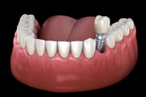 is dental implant surgery painful