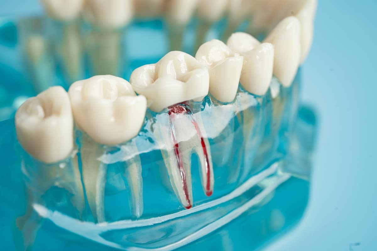 Dental crown and root canal model showing tooth restoration at North Frisco Dental & Orthodontics in Frisco, TX