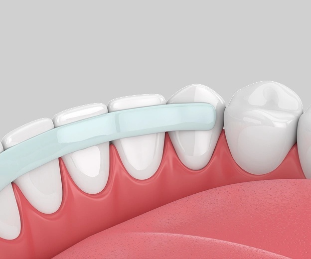 Dental Bonding 