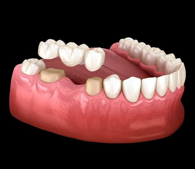 Dental Bridges 