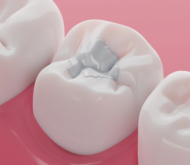 Treat Cavities Early and Protect Your Teeth