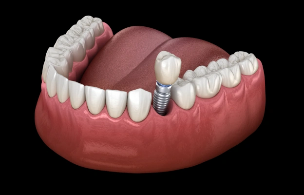 A Long-Term Solution For a Beautiful Smile With Dental Implants in Frisco, TX