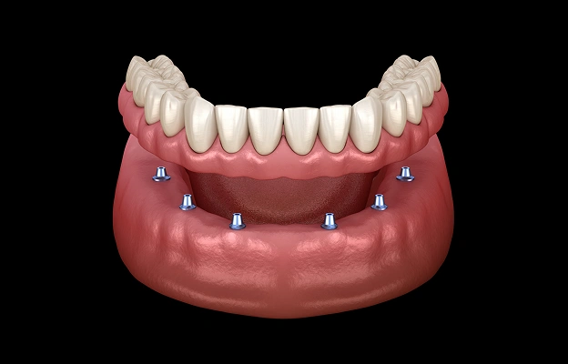 A More Secure Alternative to Traditional Dentures
